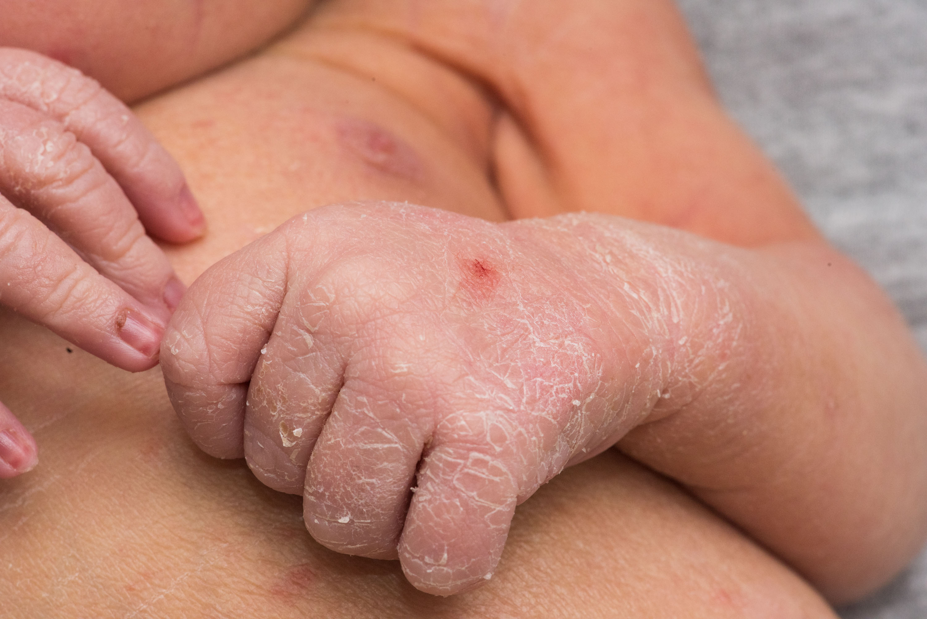 Bebis med torr hud på händerna