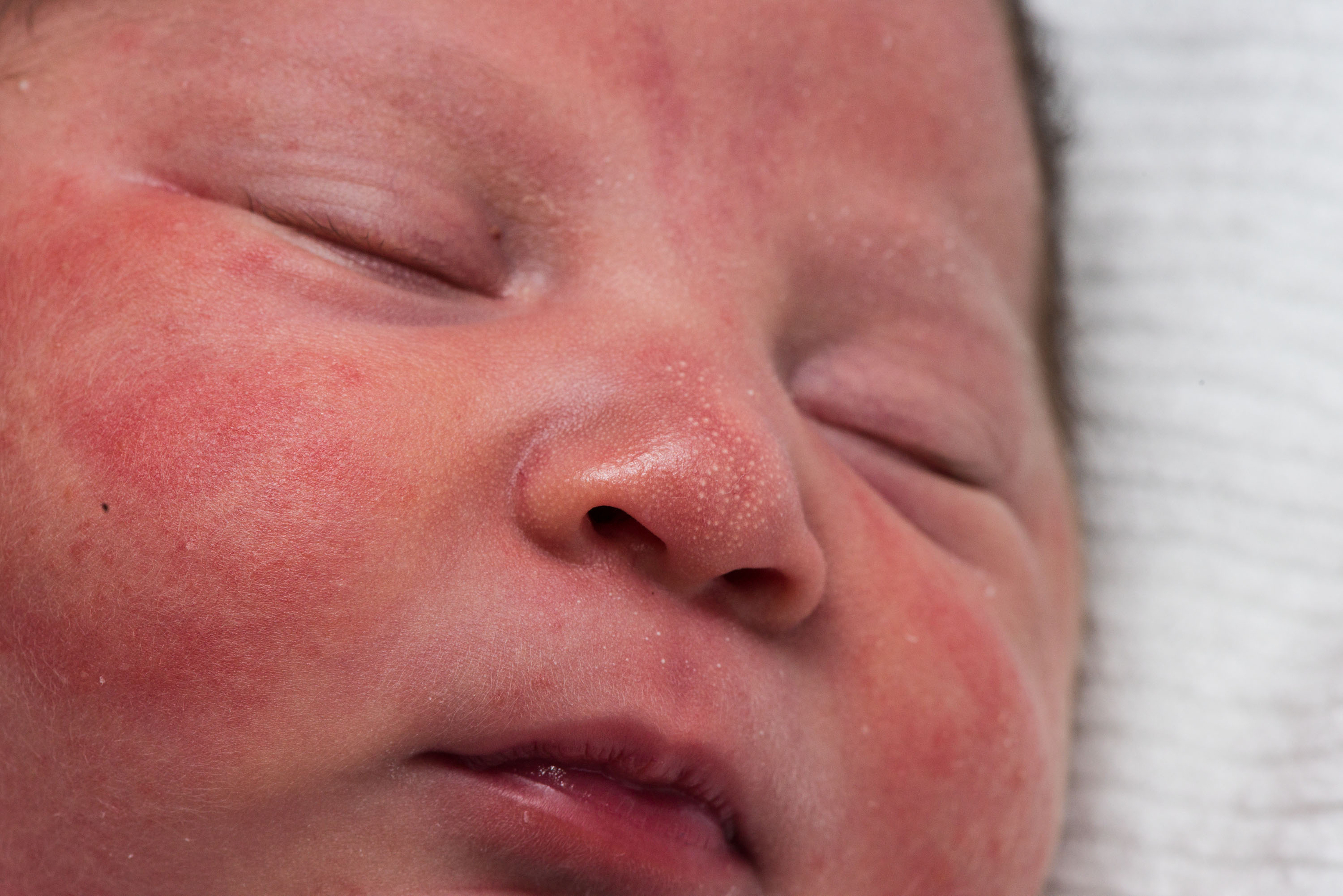 Små vita prickar på ett nyfött barns näsa
