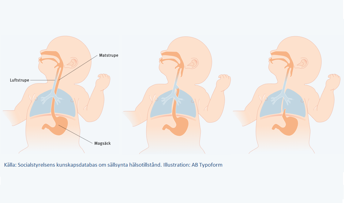Schematiserad bild på tvärsnitt barn med normal strupe samt två tvärsnitt med sjukdomstillstånd esofagusatresi